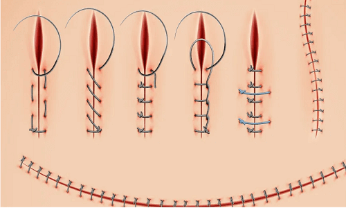 متى تطيح خيوط العمليةالتجميلية للمهبل 1