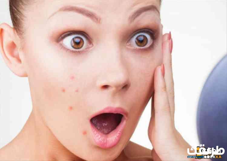 أهم الوصفات الطبيعية والطرق للتخلص من حب الشباب وآثارها 6 أهم الوصفات لازالة الحبوب واثارها من البشرة