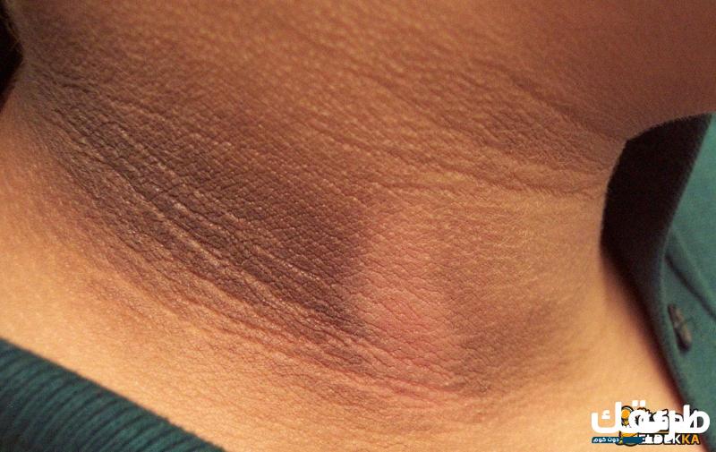 طرق طبيعية لعلاج كلف الحمل في الرقبة 2 طرق طبيعية لعلاج كلف الحمل في الرقبة