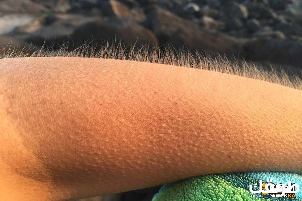 تجربتي في علاج جلد الوزة بطرق طبيعية وأهم المسببات له 7 تجربتي في علاج جلد الوزة