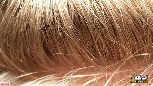 تفسير حلم نزع القمل الأسود من الشعر للعزباء 6 تفسير حلم نزع القمل الأسود من الشعر للعزباء