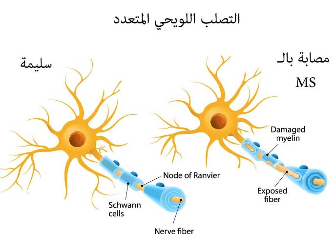 أعراض التصلب اللويحي عند النساء