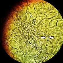 Vaginal wet mount of candidal vulvovaginitis