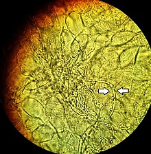 Vaginal wet mount of candidal vulvovaginitis