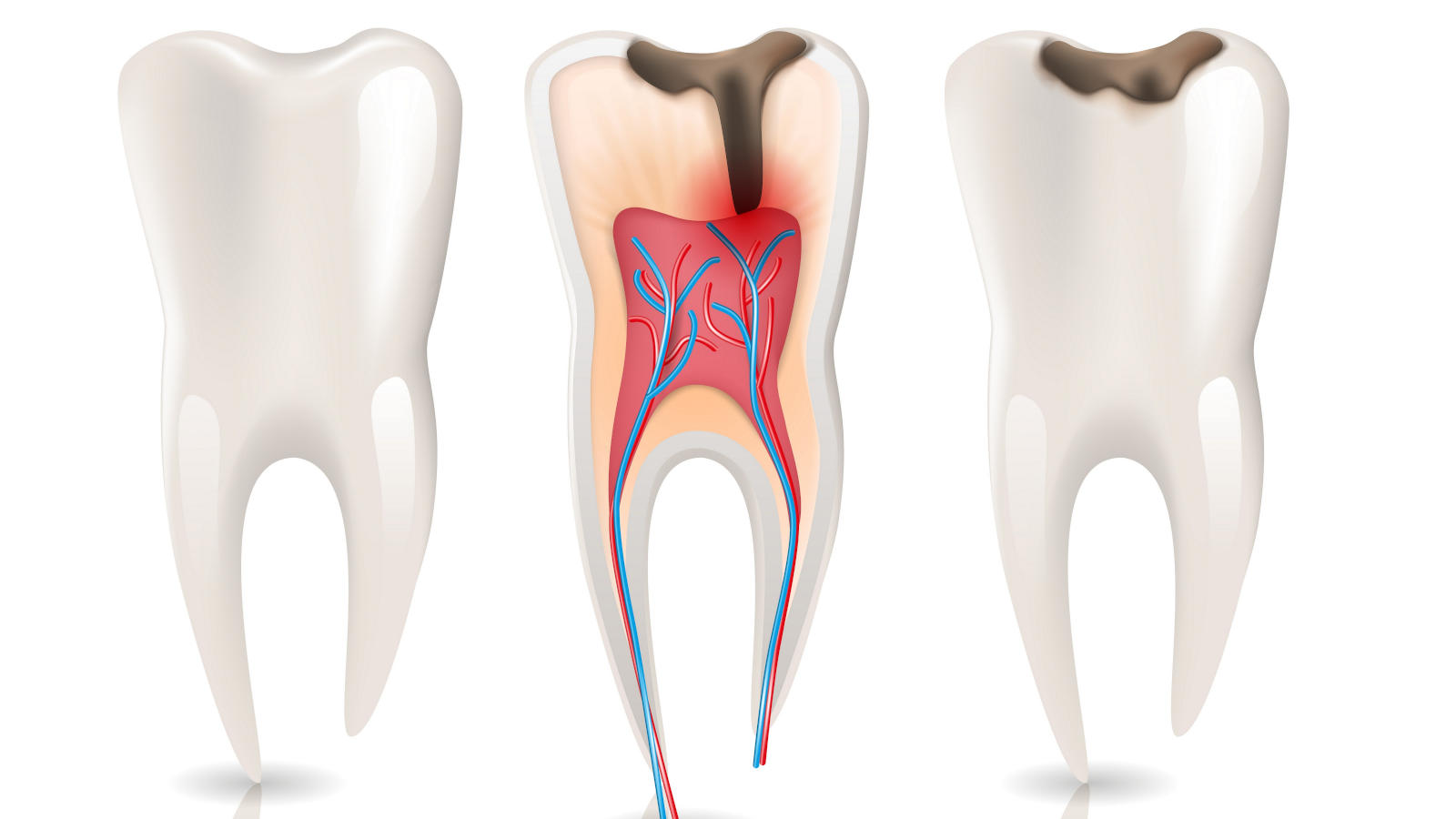 root canal