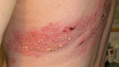 أفضل مرهم لعلاج الحزام الناري 6 أفضل مرهم لعلاج الحزام الناري