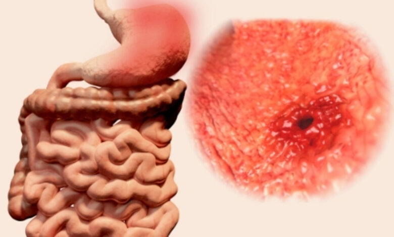 أعراض الإصابة بمرض القرحة المعدية وطرق علاجها 1 أعراض الإصابة بمرض القرحة المعدية وطرق علاجها