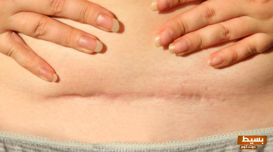 تفسير حلم جرح في البطن بدون دم في المنام 5 تفسير حلم جرح في البطن بدون دم في المنام