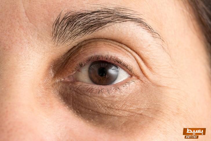 وصفات للهالات السوداء تحت العين للدكتور سعيد حساسين 5 وصفات للهالات السوداء تحت العين للدكتور سعيد حساسين