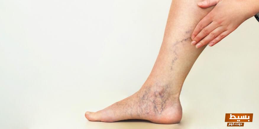 وصفة لإزالة الدوالي نهائياً 2 وصفة لإزالة الدوالي نهائياً