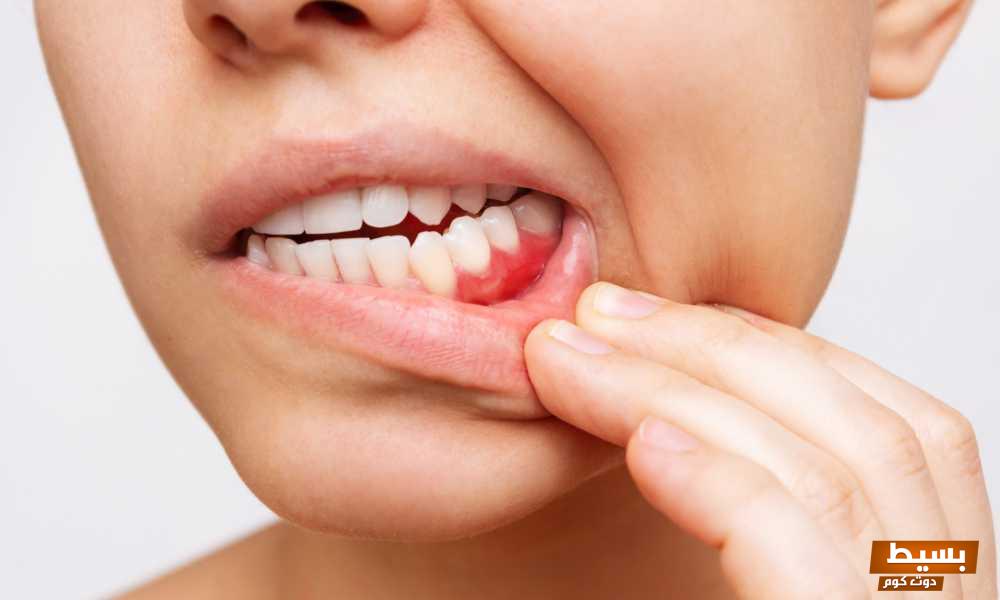 علاج التهاب اللثة وانتفاخها في البيت 3 علاج التهاب اللثة وانتفاخها في البيت
