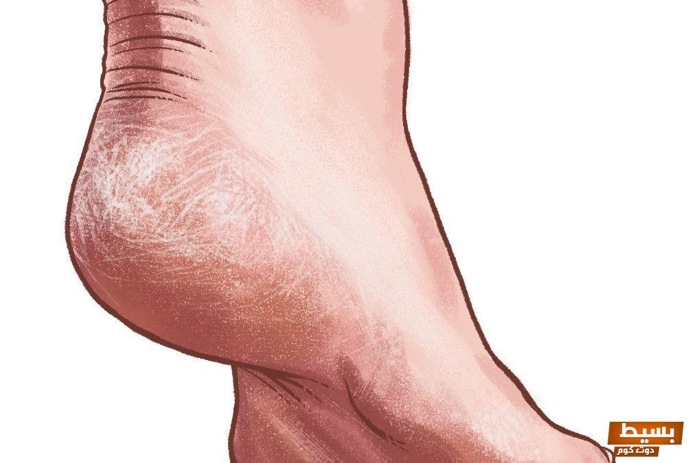 وصفة مجربة لتشقق القدمين 8 وصفة مجربة لتشقق القدمين