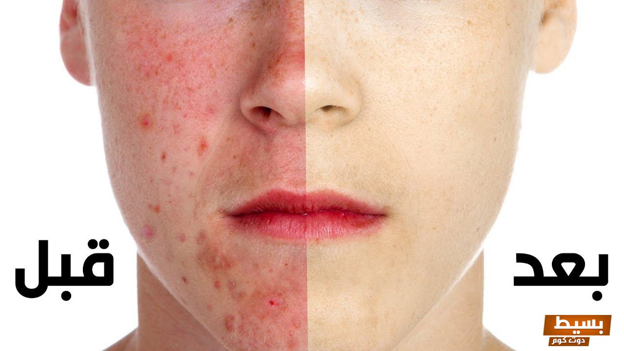 وصفة لإزالة الحبوب من الوجه للدكتور سعيد حساسين 5 وصفة لإزالة الحبوب من الوجه للدكتور سعيد حساسين