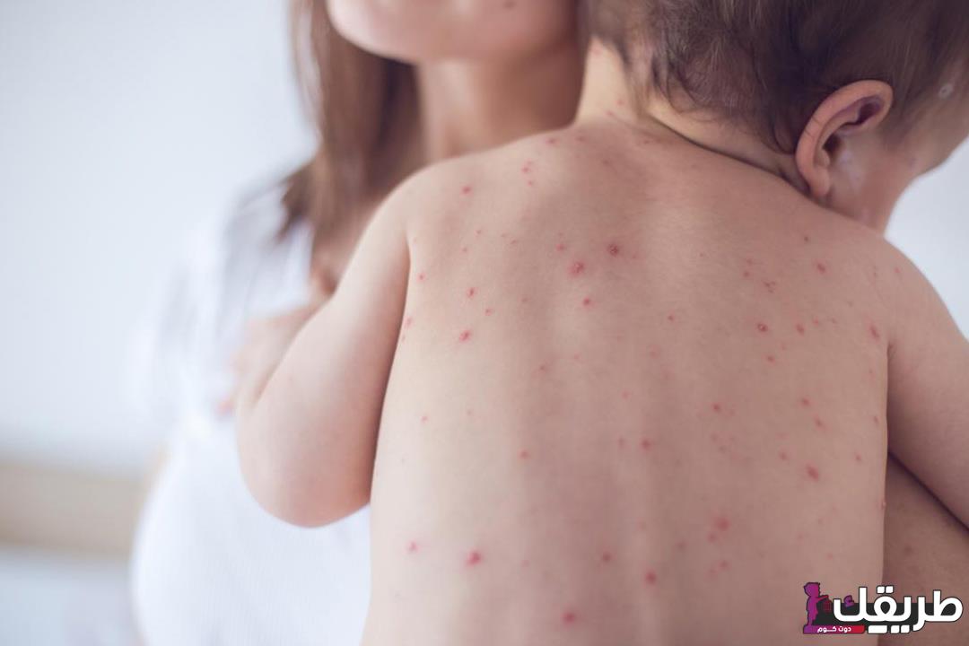 تجربتي الخاصة مع النخالة الوردية وأعراضه وطرق علاجها 4 2019 10 21 13 54 45 409