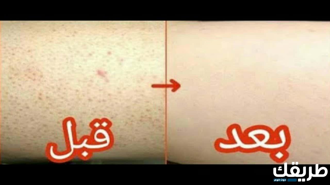علاج سريع للتخلص من جلد الوزة في أقل من 7 أيام 4 296885189176554