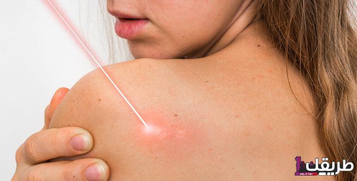 تجربتي مع الكيس الدهني في الظهر وطرق علاجة 2 2df9a640 6944 11ed a208 0050568b0c83