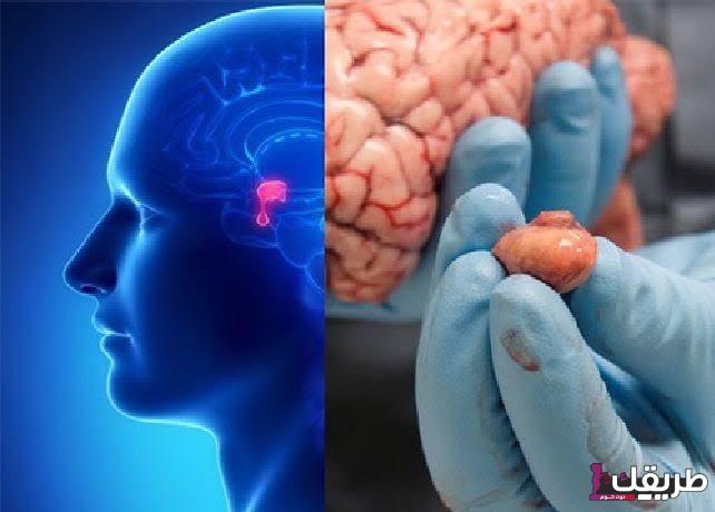 تجربتي مع ورم الغدة النخامية وعلاجها وأعراضها 5 31338 ما هي الغدة النخامية