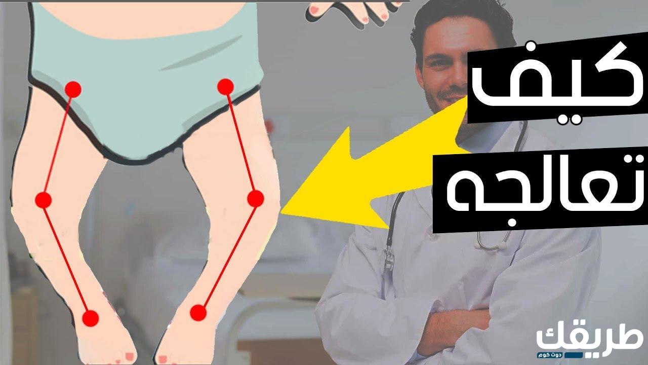 تجربتي مع عملية تقوس الساقين