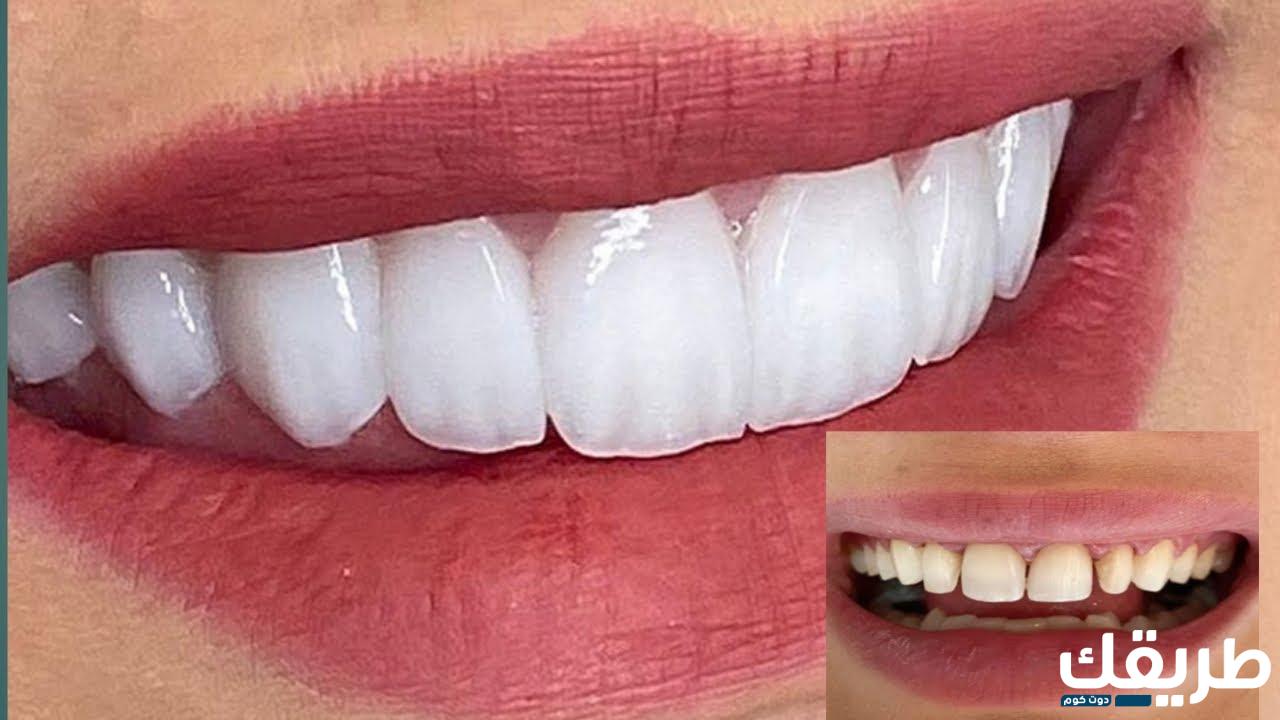 تكلفة ابتسامة هوليود وفوائدها واسعارها بالتفاصيل الكاملة 6 356741243421761