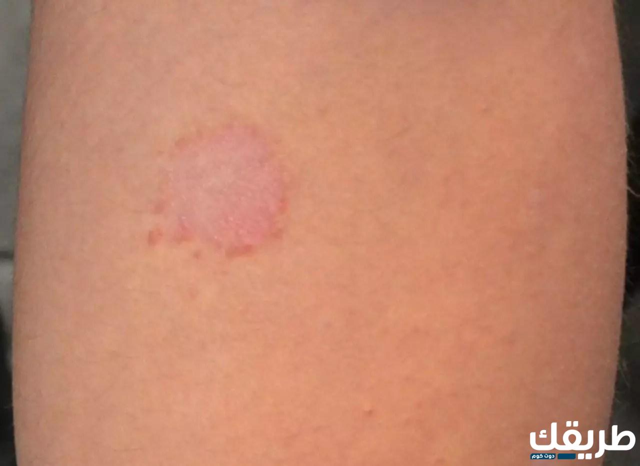 تجربتي مع النخاله الورديه وأسباب الإصابة بها وأعراضها 5 408522789340843