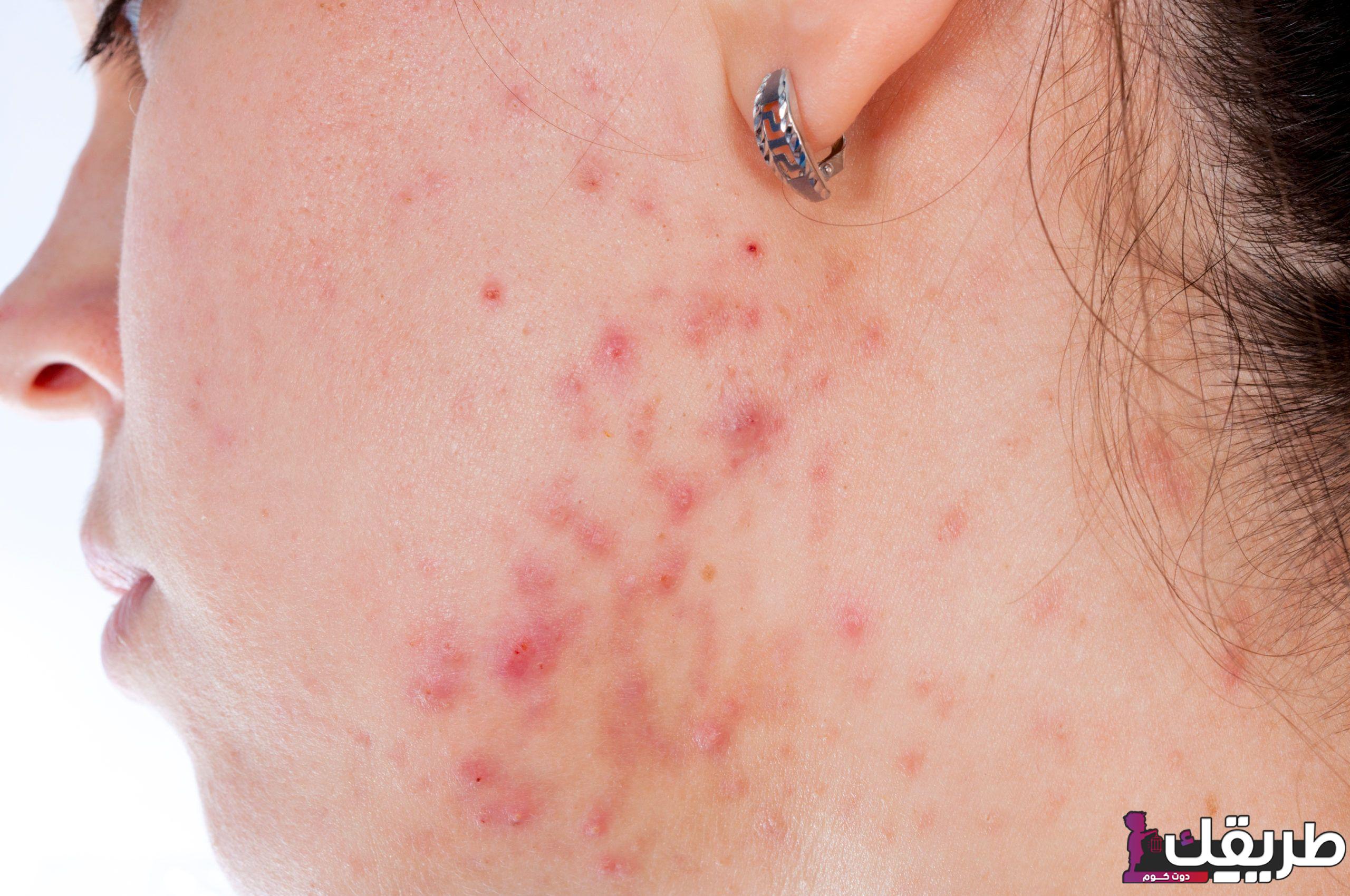 طريقة علاج الاكزيما الدهنية وتساقط الشعر وأشهر 4 أعراض تدل عليها 3 431478066949243