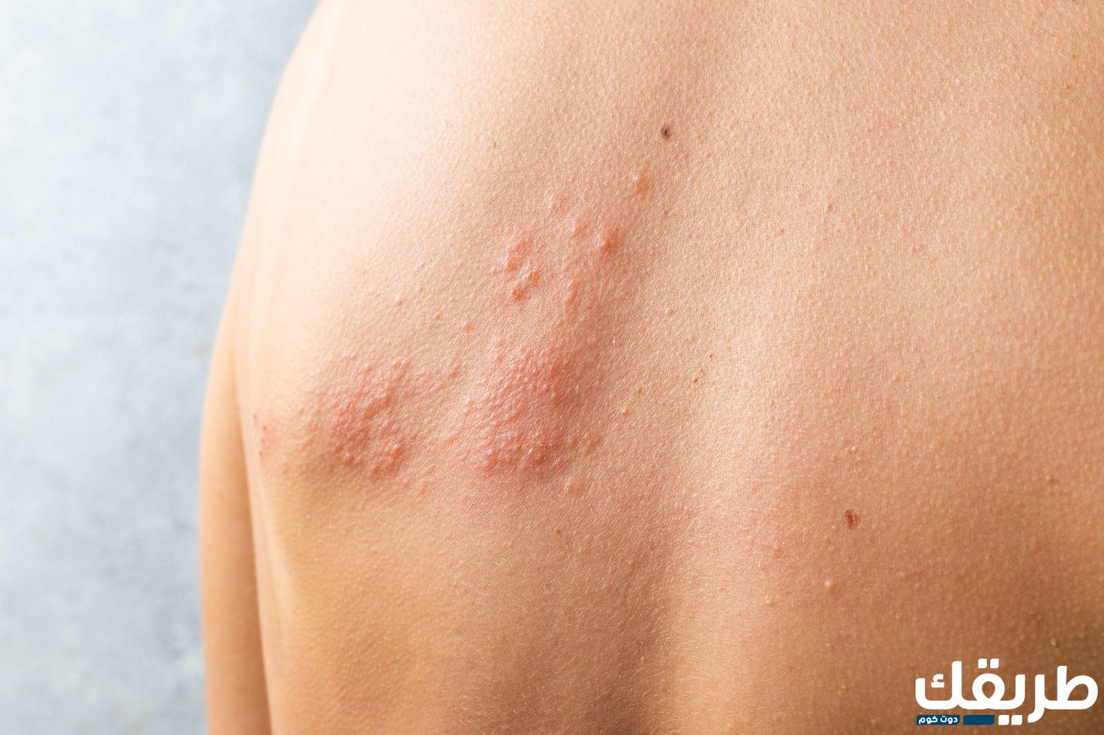 تجربتي مع الحزام الناري وأسبابه وأعراضه 7 445663840105423