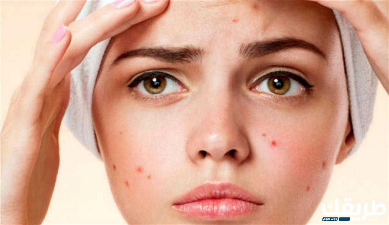 هل نت لوك Net Lock يزيل آثار الحبوب 4 494702285280063