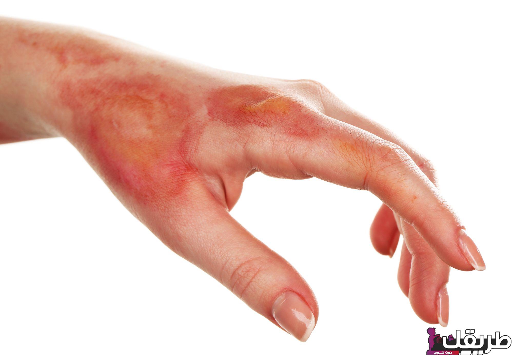 أفضل كريم للحروق من الدرجة الأولى ونصائح الإسعافات الأولية 5 663361479430046