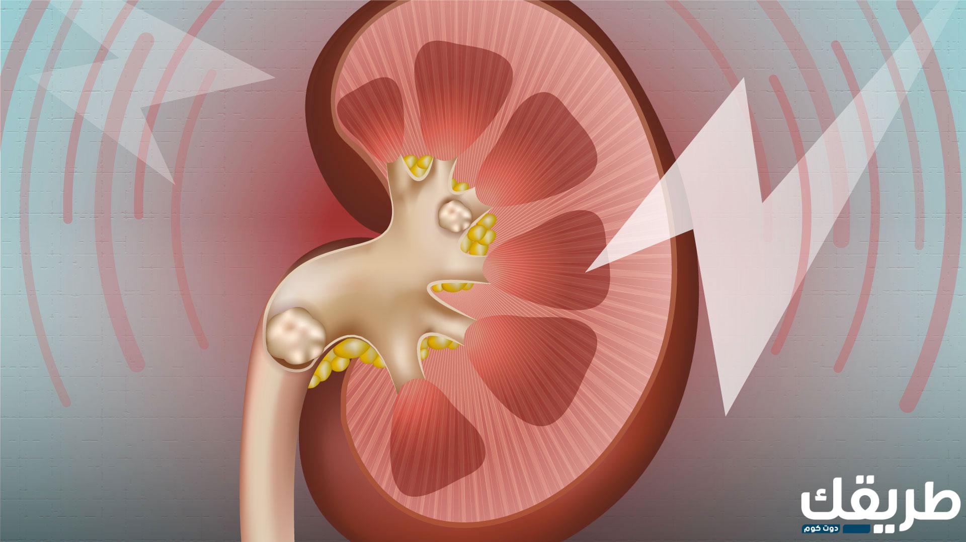 ما هو توسع حوض الكلى للجنين؟ وماهى درجاته 2 88417673615534