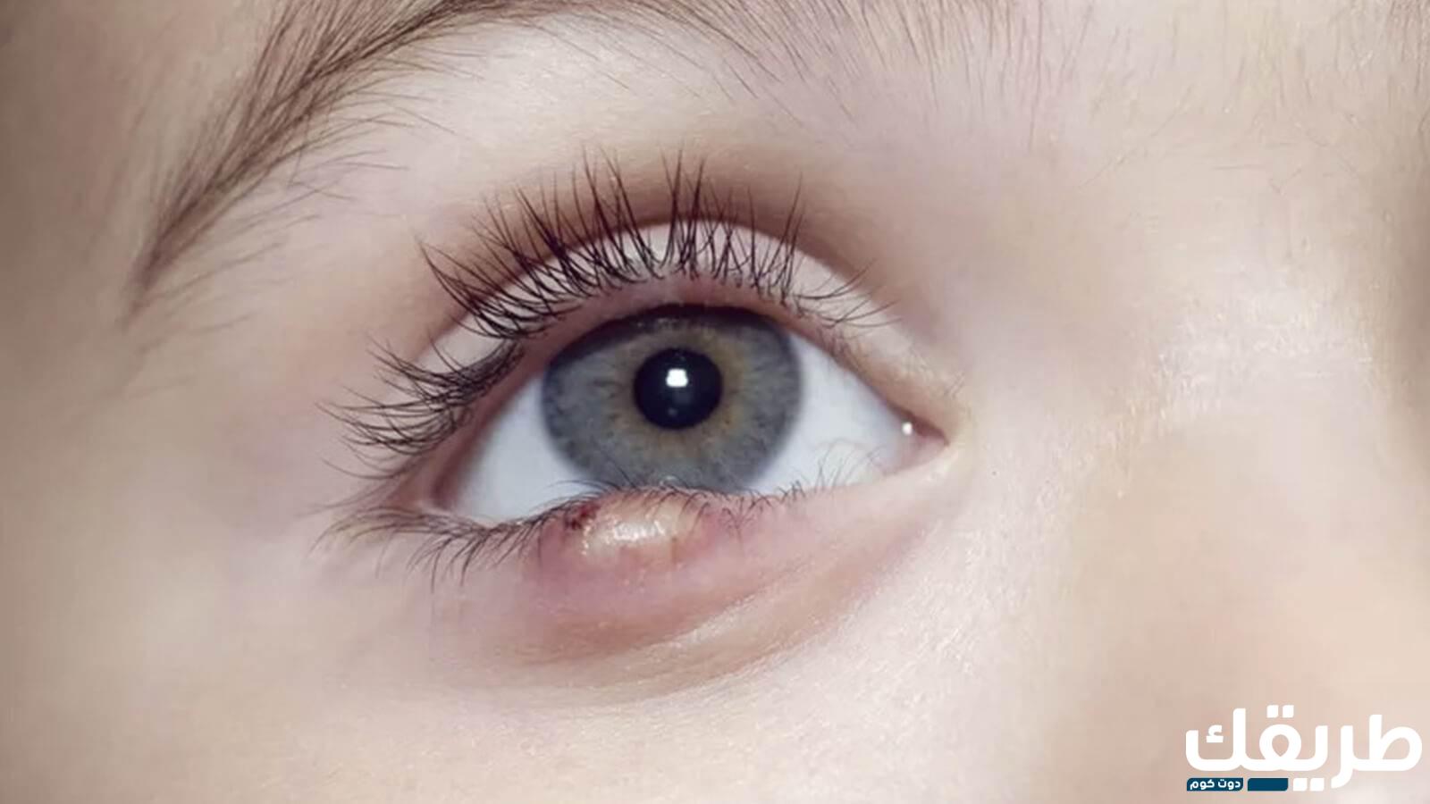 تجربتي مع كيس الدهني في العين 5 89302421603176