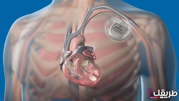 تجربتي مع منظم القلب وأسباب استخدامه وأشهر أنواعه 1