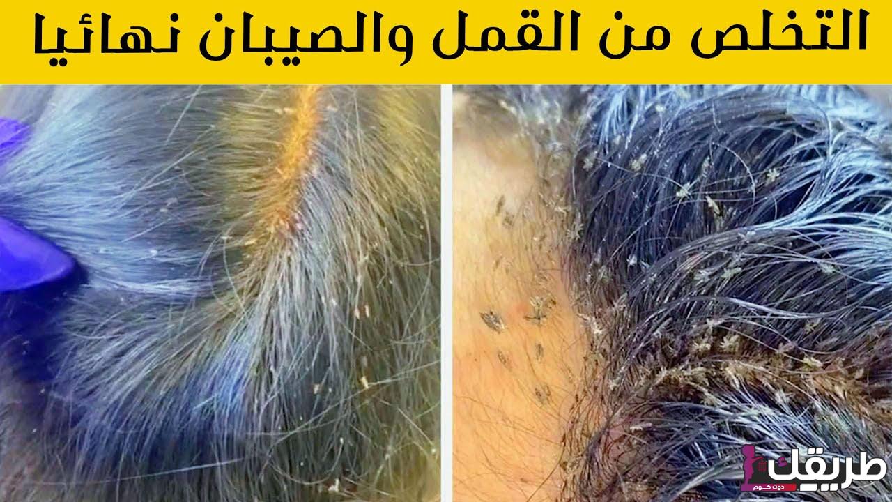 علاج القمل في المنزل بطرق بسيطة 6 maxresdefault 31 1