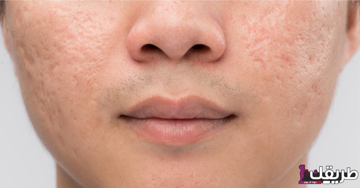 تجربتي مع تقطيع الندبات والتخلص منها بطرق طبيعية غير مكلفة 2 tbl articles article 23837 7248da32bb 962c 4d08 af30 8f622c196f6f