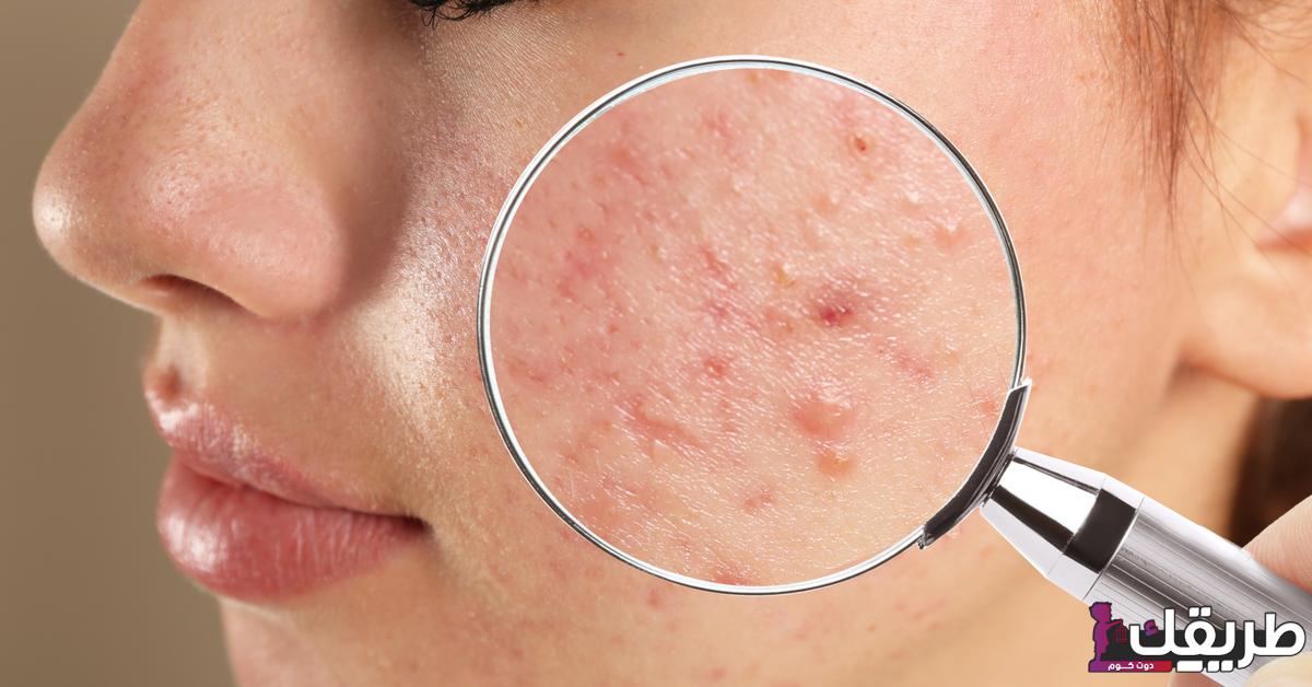 تجربتي في التخلص من حبوب الوجه بدون كريمات 5 tbl articles article 28079 579311c0027 2e81 49c5 8489 5f5d103e36fe