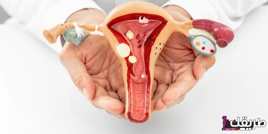 قرحة عنق الرحم هل تمنع الحمل؟ كيفية علاج قرحة الرحم 5 tbl articles article 30921 401c68623ec d900 4c7f be67 5bd766665d5e