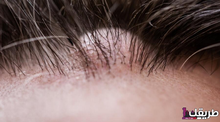 تجربتي مع الكيس الدهني في الراس وطريقة فعالة وسريعة للعلاج 3 tbl articles article 32913 782574e562e 1874 4b19 a92b a4e10ea033c2