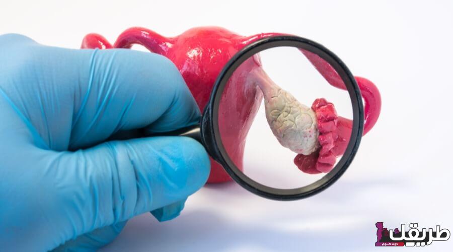 أهم علامات نزول تكيسات المبايض مع الدورة الشهرية 5 tbl articles article 35678 698536b696f 9d3e 4be0 875f 91afdcb367f1