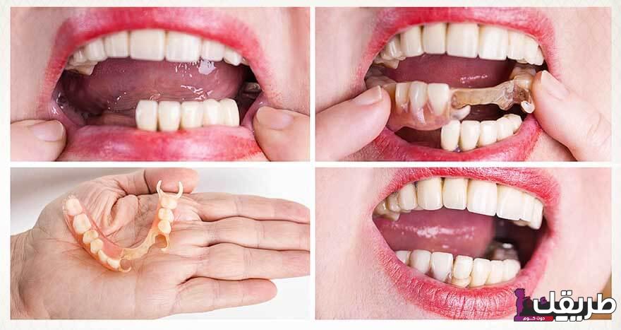 تجربتي مع جسر الأسنان وخطوات تركيبه وتنظيفه 4 الجسور المتحركة