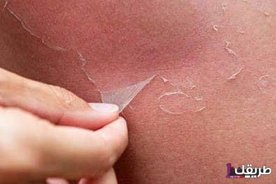 تجربتي مع التقشير الكيميائي للمنطقة الحساسة 7 تقشير البكيني