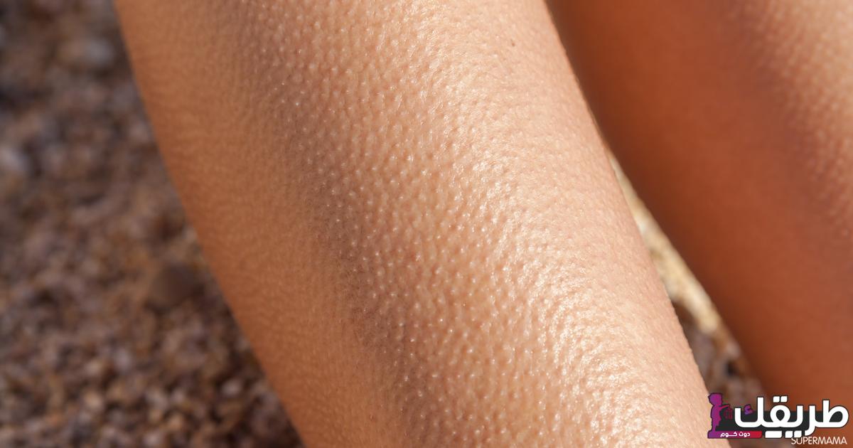 تجربتي في علاج جلد الوزة في البيت بطرق طبيعية 3 صورة بعنوان علاج جلد الوزة