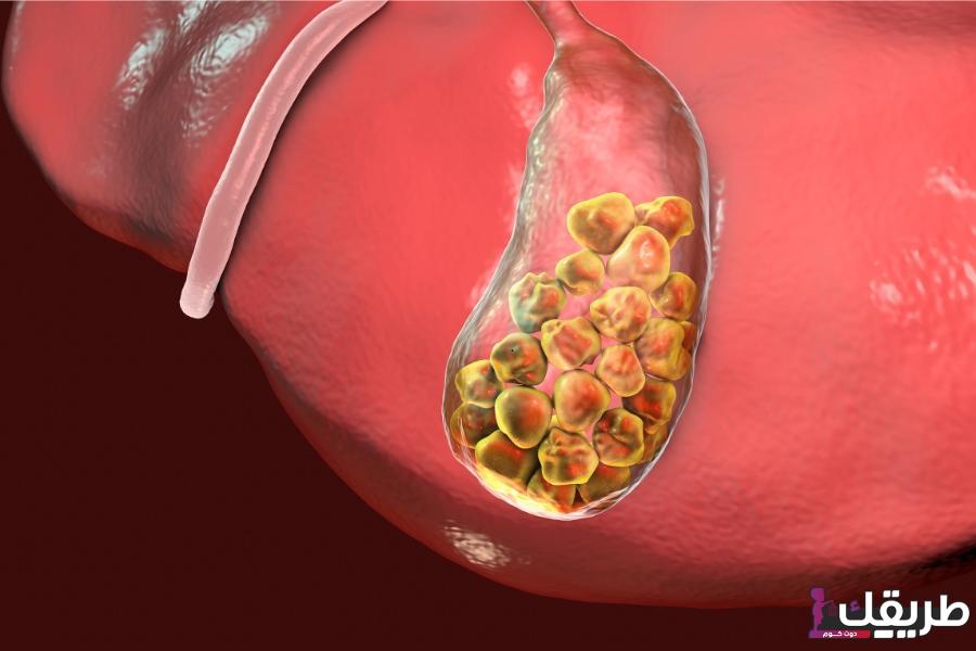 علاج حصوات المرارة في يوم واحد بإذن الله