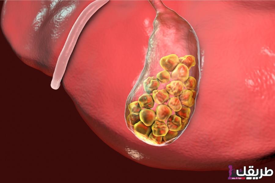 تجربتي في تفتيت حصوة المرارة وطريقة الوقاية منها 3 علاج حصوات المرارة في يوم واحد بإذن الله