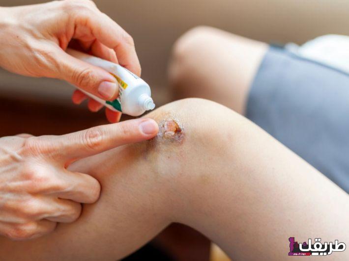 كريمات تساعد على التئام الجروح بسرعة 1 فوائد المضاد الحيوي للجروح