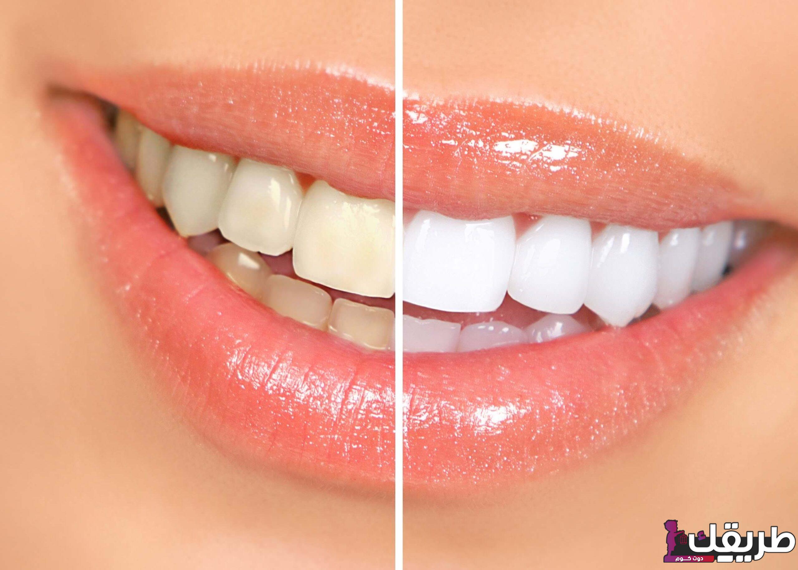 أفضل 7 طرق لتبييض الأسنان وأسباب الإصفرار 1 158097753844074 scaled