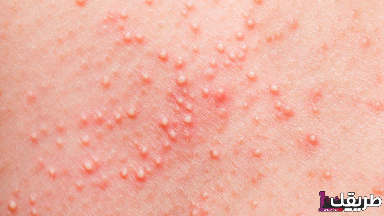 تجربتي مع أسباب ظهور حبوب برؤوس بيضاء في الجسم 3 171457217905010