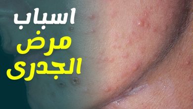 الاتحاد الأوروبي يحذر من تزايد خطر الإصابة بالجدري 6 209644946354070