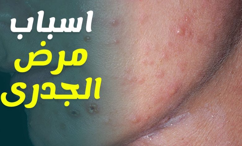 الاتحاد الأوروبي يحذر من تزايد خطر الإصابة بالجدري 1 209644946354070