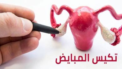 علاج تكيس المبايض للبنات بوصفات طبيعية 6 280728671133181