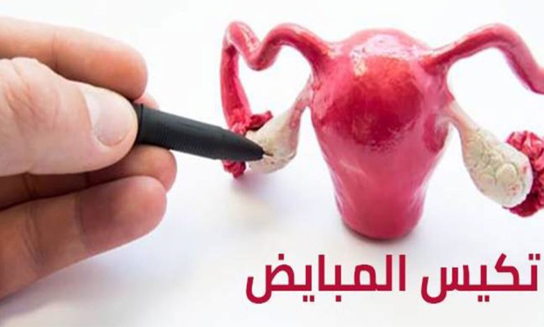 علاج تكيس المبايض للبنات بوصفات طبيعية 1 280728671133181