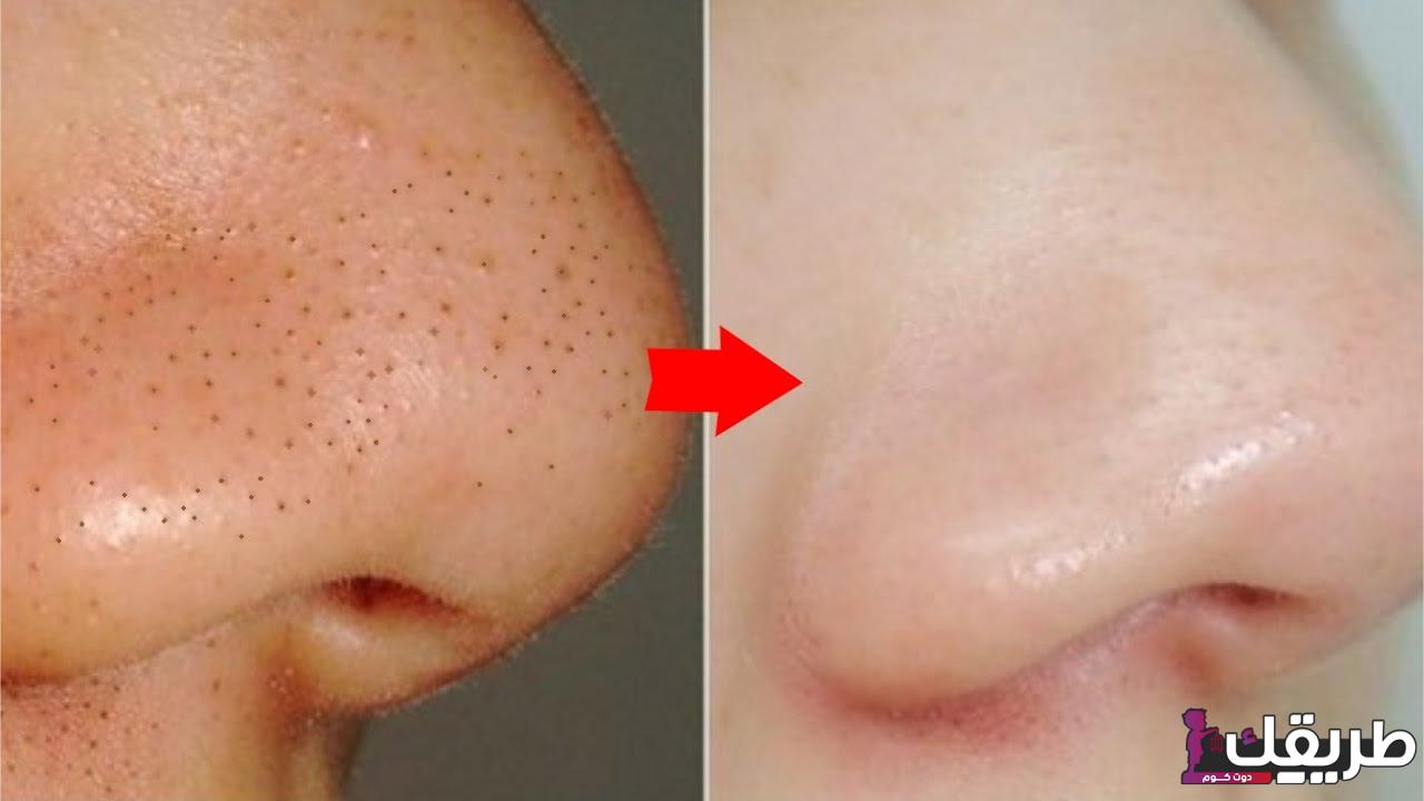 تعلمي إزالة الرؤوس السوداء من الأنف من أول مرة 2 378593021266112